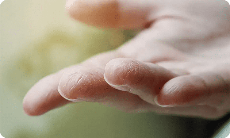 علایم خشکی پوست دست